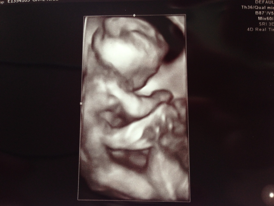 Ultrasound 24 Weeks Twin Motherhood